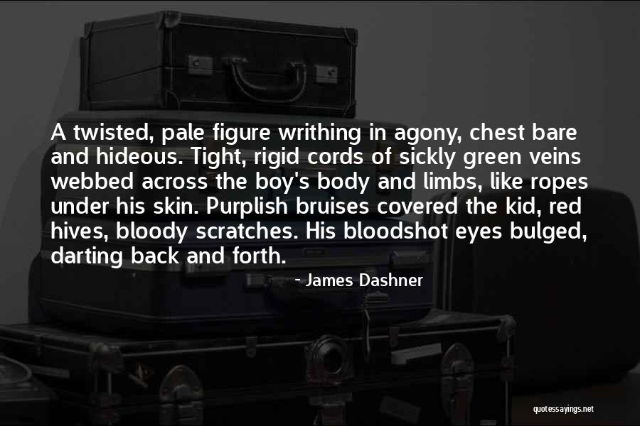 Hives On The Body Quotes By James Dashner Hives On The Body Quotes By James Dashner